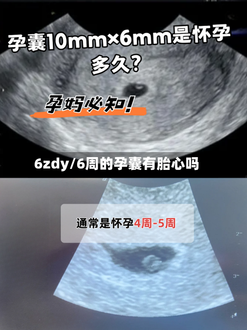 6zdy/6周的孕囊有胎心吗-第1张图片